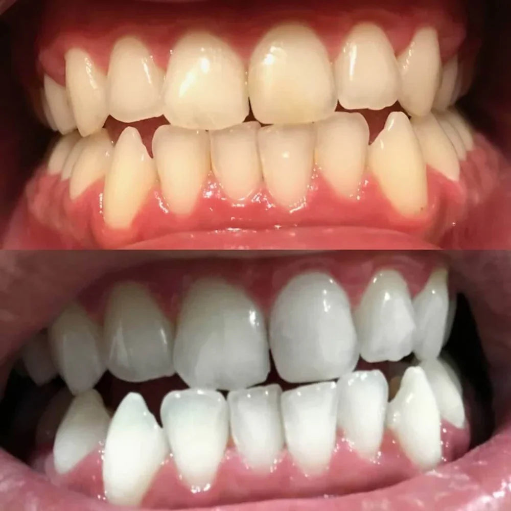 Teeth Whitening Pen - Radiant smile in 10 minutes